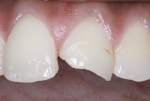 Cosmetic bonding chipped tooth.