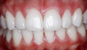 Teeth whitening with amazing results!