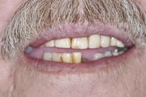 Affordable dentures in Spring TX.